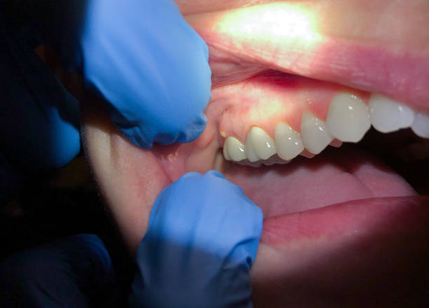 Best Broken or Chipped Tooth Repair in Huntingtown, MD
